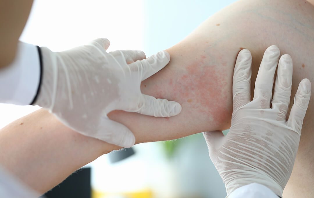 Dermatology Allergic Rash